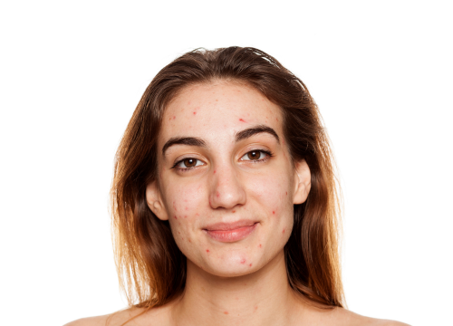 Pack routine peau mixte acnéique