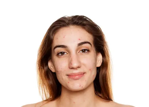 Pack routine peau mixte acnéique Les Pépites de Valou