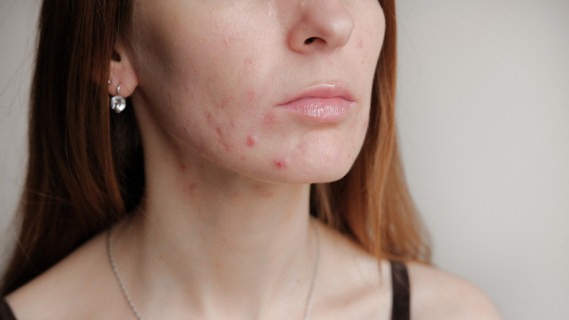 Routine de soin visage pour Peau Mixte Grasse Acnéique : conseils et astuces pour une peau équilibrée