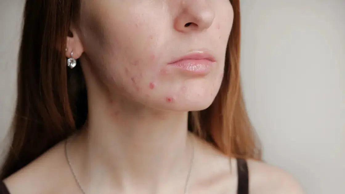 Routine de soin visage pour Peau Mixte Grasse Acnéique : conseils et astuces pour une peau équilibrée - Les Pépites de Valou
